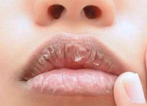 当心嘴唇出现这5种颜色可能是大病前兆