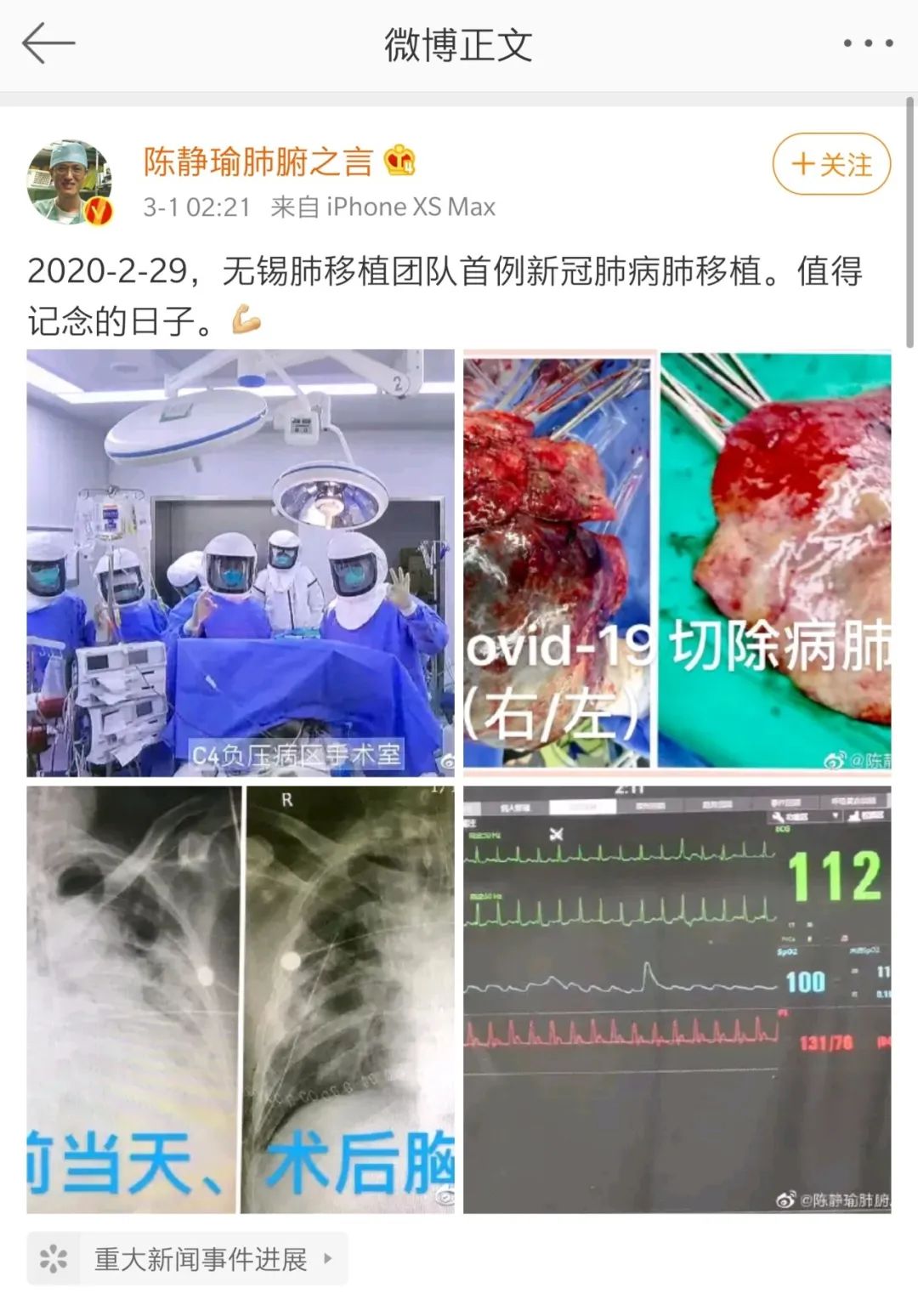 首例新冠肺炎病人肺移植术成功目前生命体征平稳