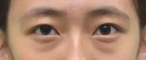 问题五:"脂肪型眼袋"