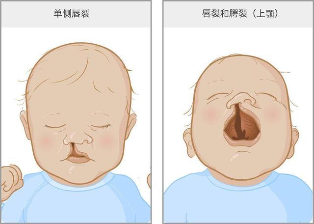 兔子很可爱兔唇宝宝是爸妈的痛防患于未然这5件事能避则避