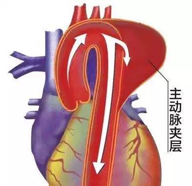 一个主动脉夹层病人的抢救,让我们深知医学的无奈和任重道远