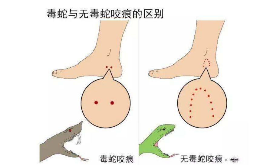 牙印,并在20分钟内,没有局部疼痛,肿胀,麻木和无力等症状,则为无毒蛇