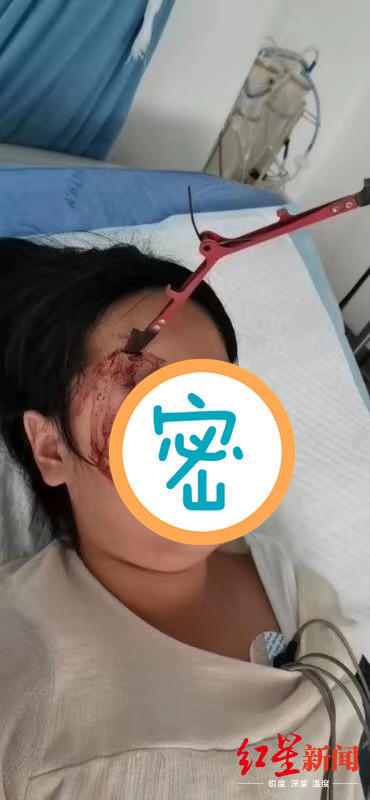 吓人!9岁女孩额头插入一把剪刀,万幸手术拔出时未出血