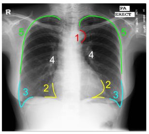 肋膈角变钝(下图#3)可能表明有胸腔积液
