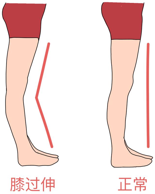 腿太直也是一种问题:膝过伸的危害与康复攻略!