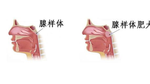 不可忽视的儿童腺样体肥大