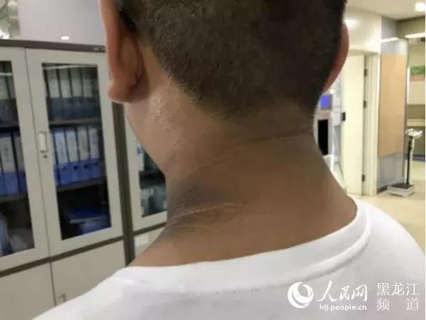 八岁男孩脖子有块黑洗不掉 一查竟是糖尿病先兆