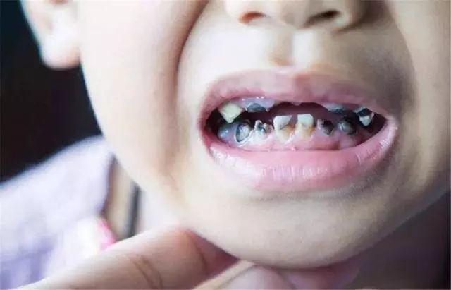 三岁大的娃,满口"小黑牙",医生检查后坦言:跟吃糖没有