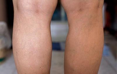 小腿莫名肿胀,或暗示血管出现堵塞,3个血栓的症状,可以自查