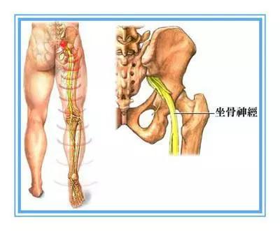 求实瑜伽丨瑜伽理疗「坐骨神经痛」的方法及练习