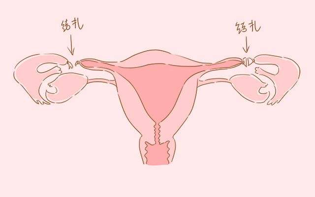原来结扎虽然对女性内分泌影响不大,但却会影响到月经周期,常常导致