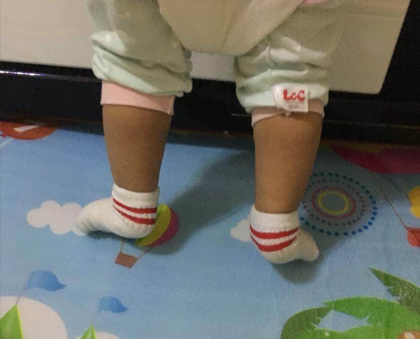 邻居家2岁的宝宝,就因为妈妈买的鞋子不合脚,造成孩子足外翻.