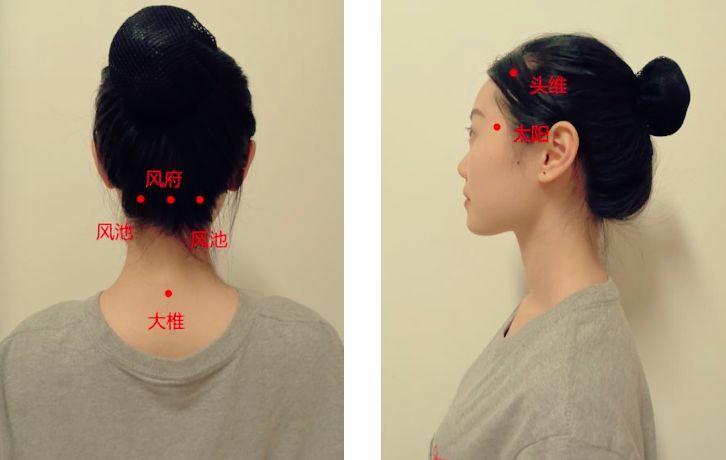 穴位按摩:可以按揉頸部的風池,風府,大椎及局部的痛點(阿是穴),頭暈