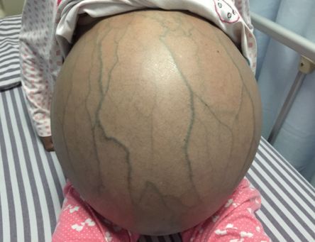 广西大姐被怪病缠身,肚子一天比一天大.