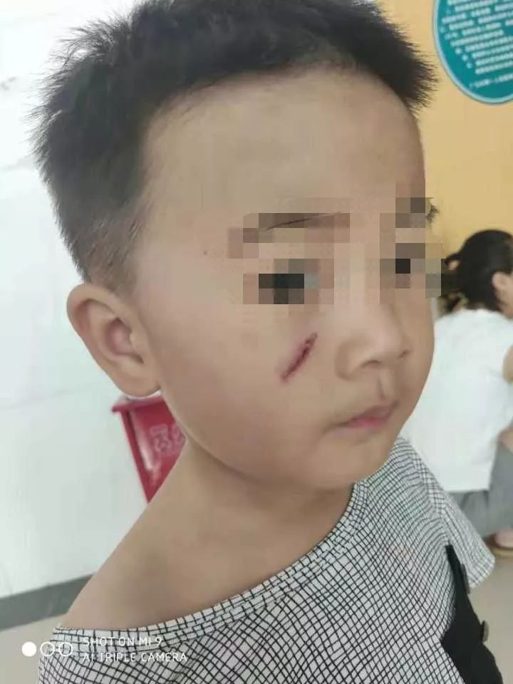 广元两岁娃玩旋转木马受伤,家长们注意看好你家小孩!