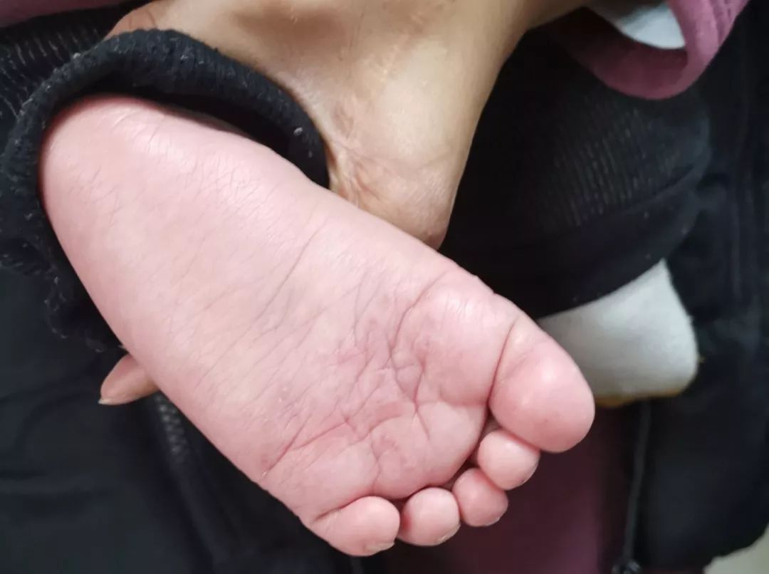 8个月的宝宝竟然得了香港脚医生梅雨季尤其要多注意