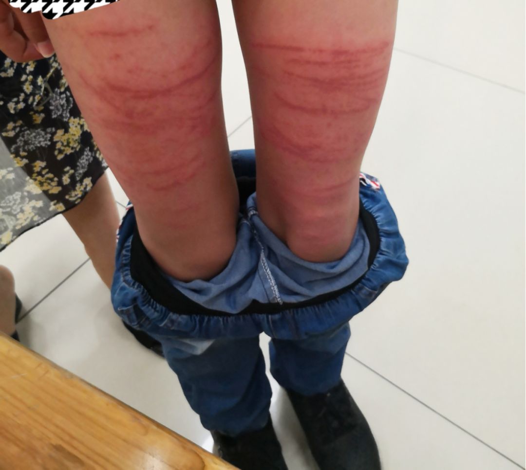 我的大腿被什么东西吸住了