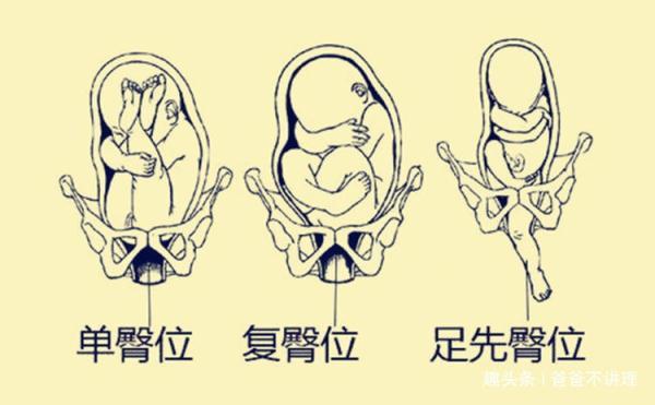 且胎儿体重超过7斤的初产妇,也不适合顺产;如果是经产妇,胎儿单臀位且