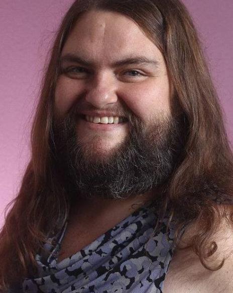 13岁女孩疯长胡须和体毛如今39岁满脸络腮胡男友并不介意