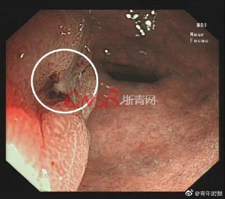 光明网：六旬阿姨胃不适好几年以为是糜烂，不想查出胃癌……还好发现及时