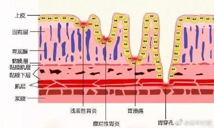 光明网：六旬阿姨胃不适好几年以为是糜烂，不想查出胃癌……还好发现及时