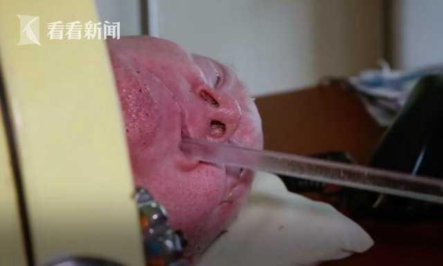 [看看新闻]男子6岁患病住“铁桶”67年？只剩头在外面 靠惊人毅力成为律师