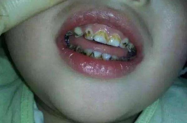 [光明网]孩子不到3岁，满口小黑牙，医生却说：不是因为糖，而是父母无知