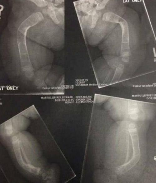[光明网]3岁轮椅女孩患骨骼疾病，乐观的她为实现梦想，用独特方式跳芭蕾