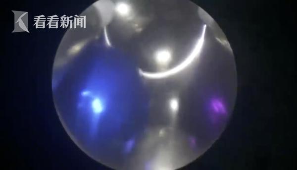 #中国经济网#58岁男子就医支支吾吾 拍X光片发现尿道塞28颗钢珠