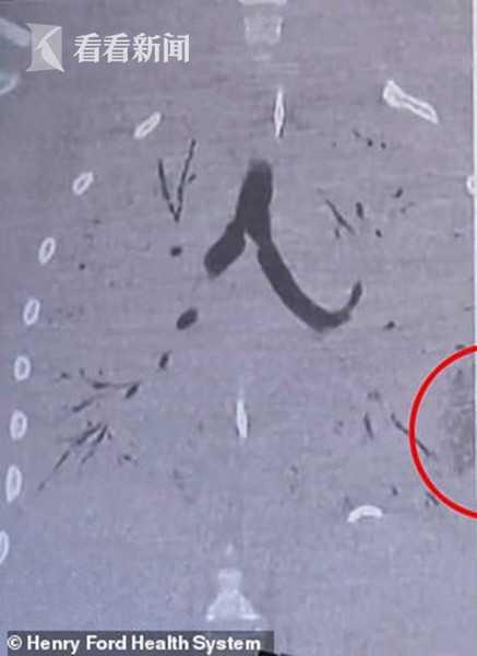 【中国经济网】17岁少年双肺坏死插管濒亡 医生：吸电子烟的下场