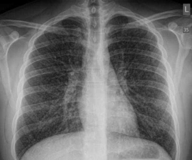 「中国青年网」沉迷电子烟 加拿大少年患上“爆米花肺”