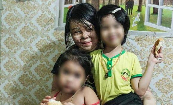 [光明网]女子提出离婚被丈夫烧毁容，如今经历16次手术称后悔结婚太早