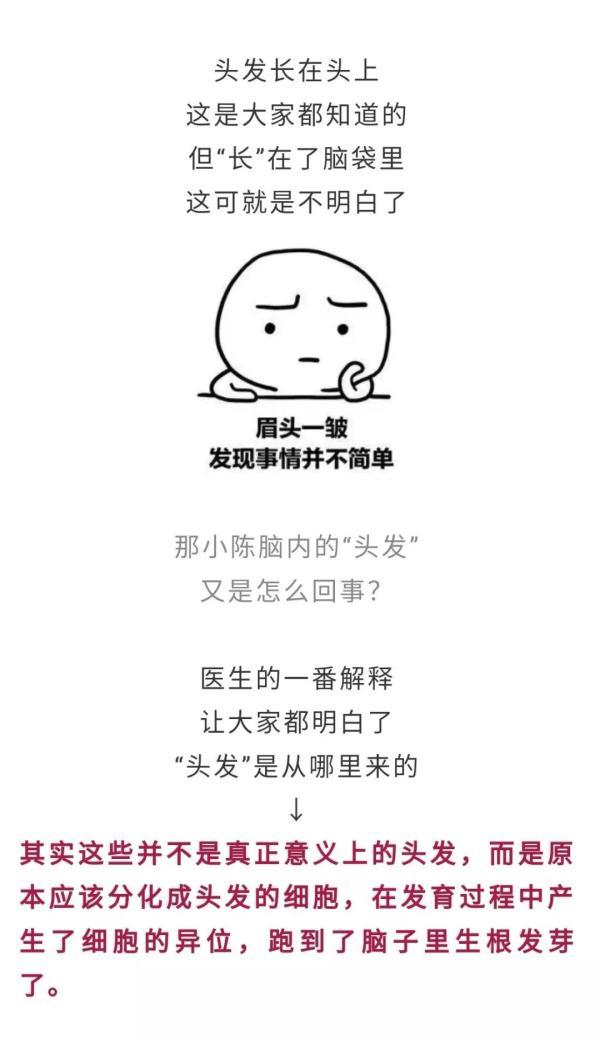 光明网：女子头脑里面竟长出一团“头发”，若“理发”太晚会危及生命