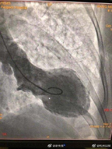 #光明网#女子吵架后突然心碎！医生：中年女性更易“心碎”