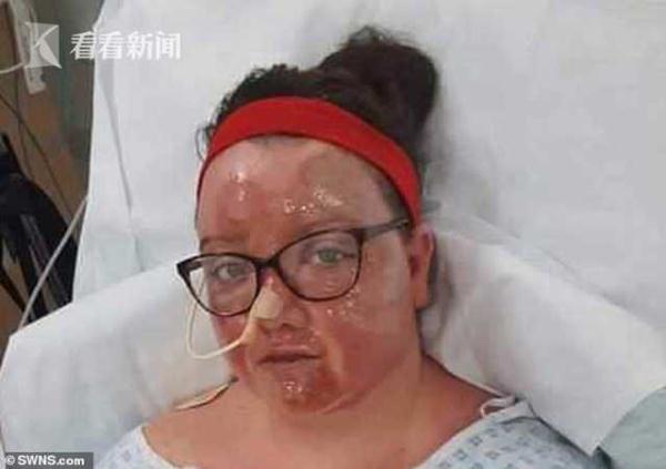 [光明网]女子坐热气球撞高压线烧成这样 求索赔百万英镑