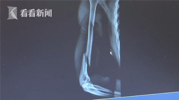 看看新闻■同学间掰手腕互不服输 咔嚓一声手断了