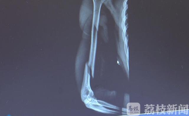 【环球网】咔嚓！小伙扳手腕居然扳断了臂骨