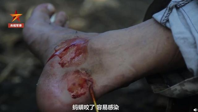 边防战士冻伤的脚图片