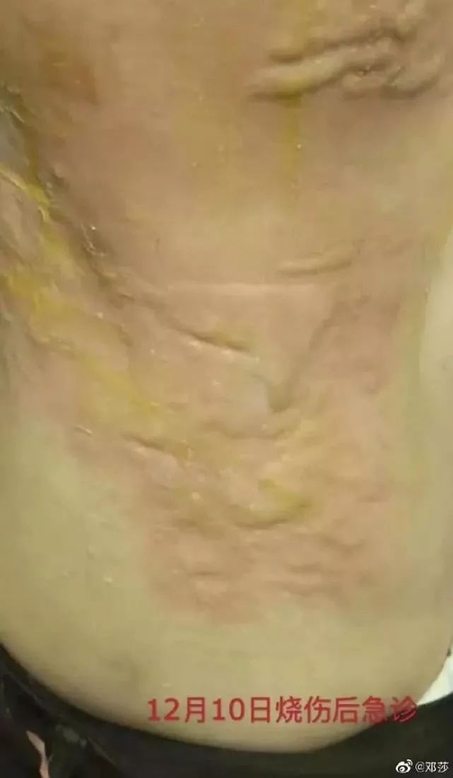 东北网■【注意】女子拔火罐出事了！隔着屏幕都觉得疼！