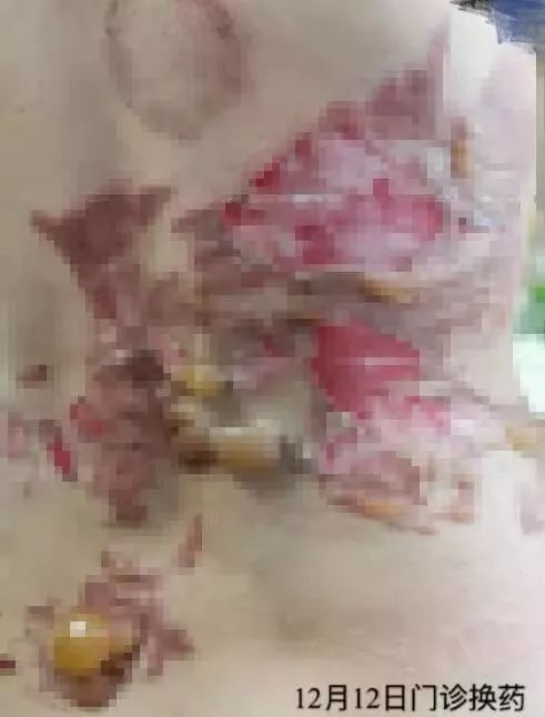 东北网■【注意】女子拔火罐出事了！隔着屏幕都觉得疼！