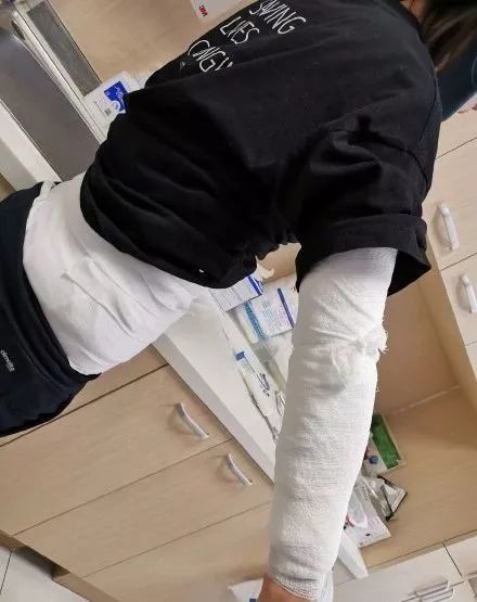 东北网■【注意】女子拔火罐出事了！隔着屏幕都觉得疼！