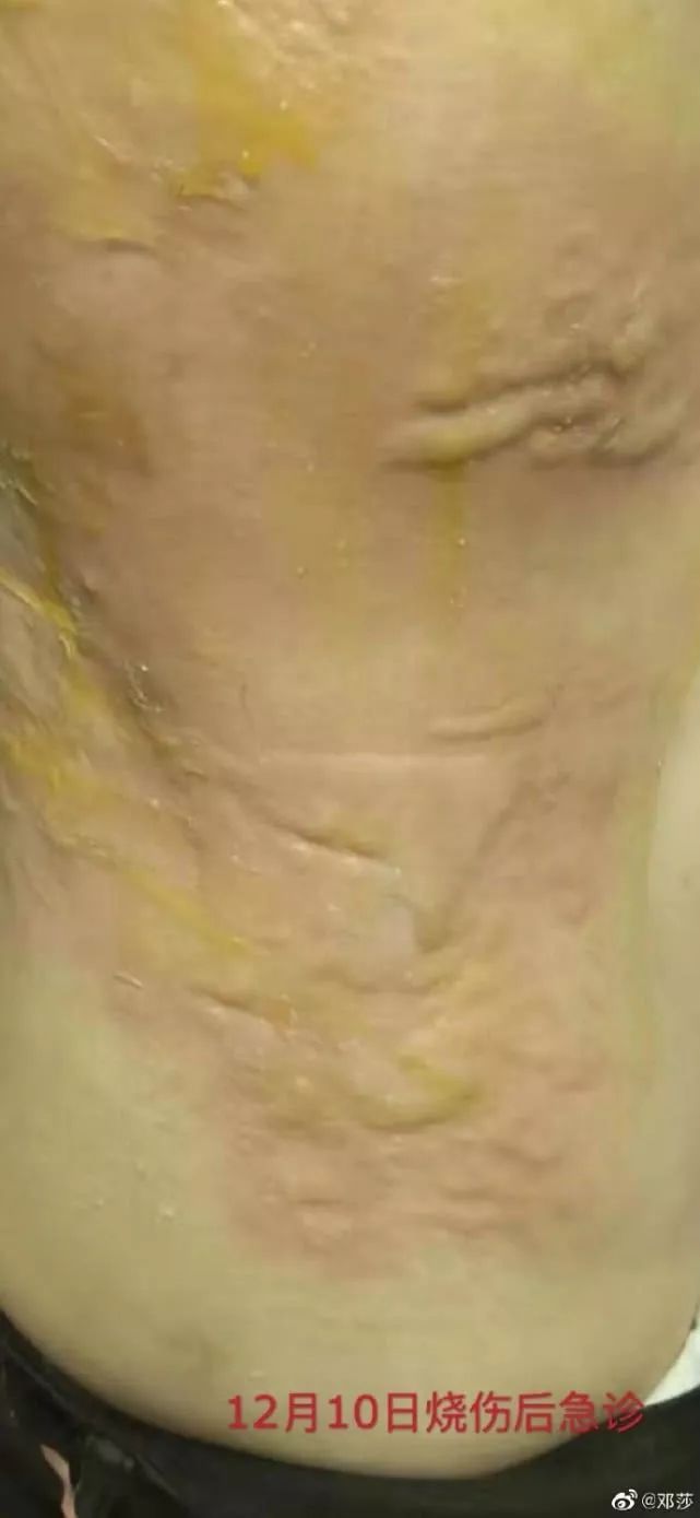 环球网@女演员曝拔火罐被深度烧伤，没想到如此严重！