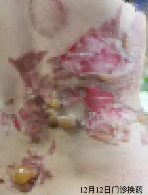 环球网@女演员曝拔火罐被深度烧伤，没想到如此严重！