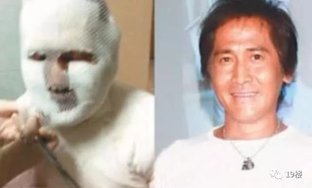 环球网@女演员曝拔火罐被深度烧伤，没想到如此严重！