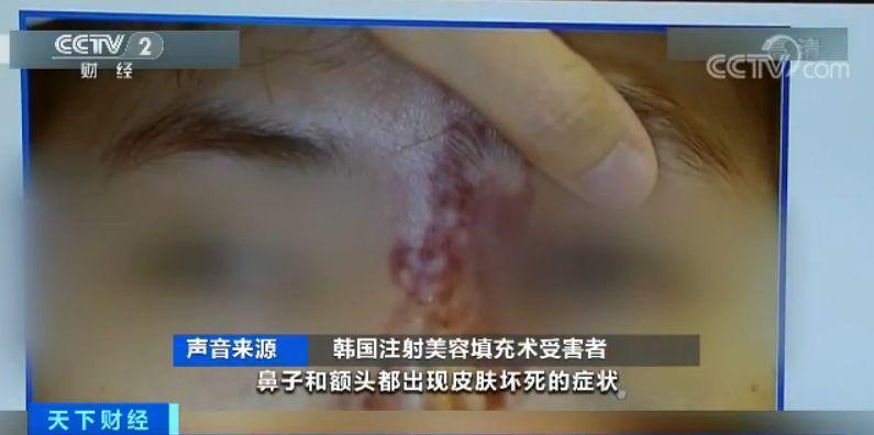 【央视财经】“幽灵手术”致数百人死亡之后，韩国整容乱象曝出：你可能花了5倍的钱！有的50%被抽走！