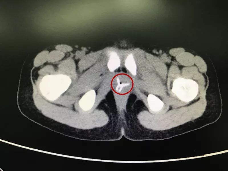 女孩肚子痛还流血,隔了几天走路都不对劲!医生一查,竟是下体塞了