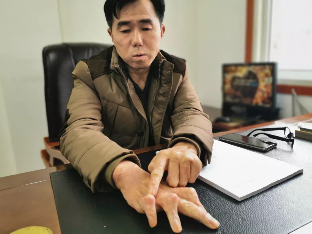 1月13日,陈磊被烧伤的手指起了脓包.