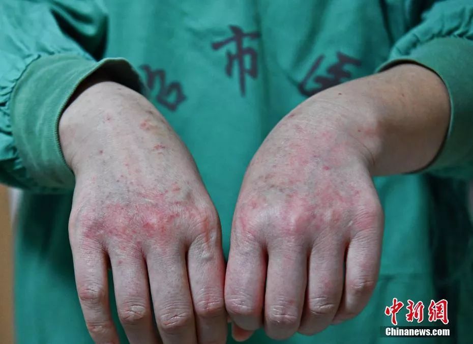 武汉大学人民医院医生程少华身着防护服超4个小时全身湿透