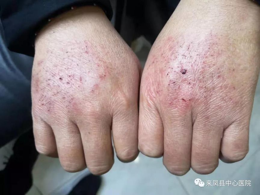 健康中国：【你有多美】“疫”线日记：我想握住你的手