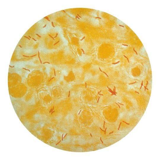 红色部分为痰中的结核分枝杆菌